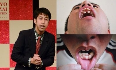 일본인 치열에 대한 이미지 검색결과