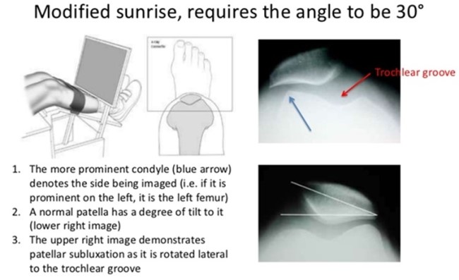 Knee X Rayì Anatomyì Positioning Ë¤ì´ë² Ë¸ë¡ê·¸