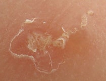 Scabies 옴 네이버 블로그